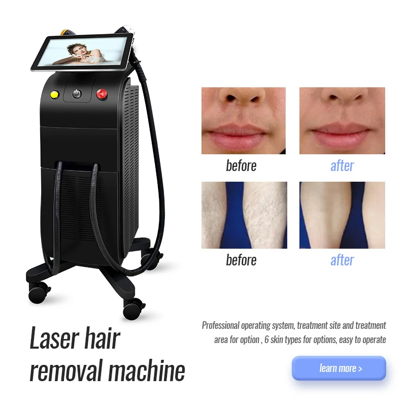 Hair Remover Laser