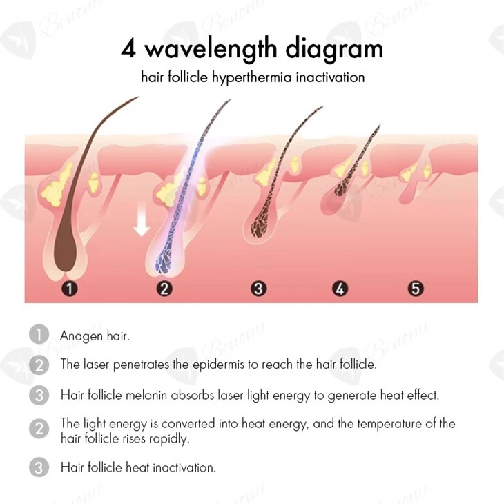 The Most Advanced 4-wavelength Diode Laser Hair Removal Machine
