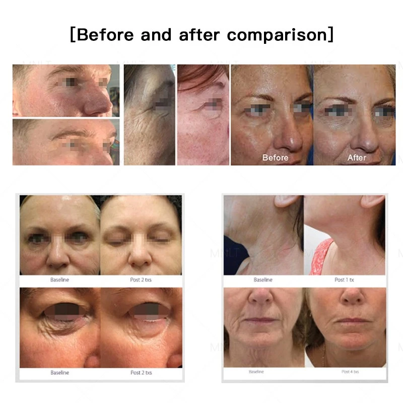 Cold And Hot Plasma Machine: Triple-Action Skin Revival & Air Purification System