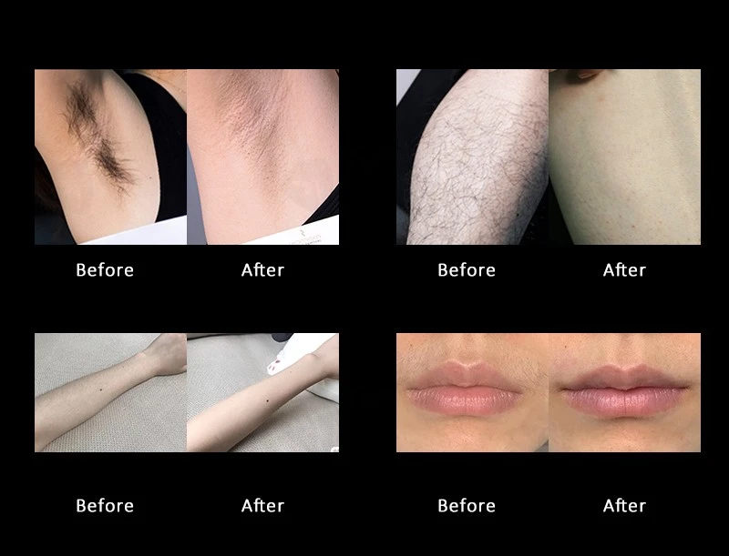 Long-Lasting Laser Technology | Laser Hair Removal Equipment
