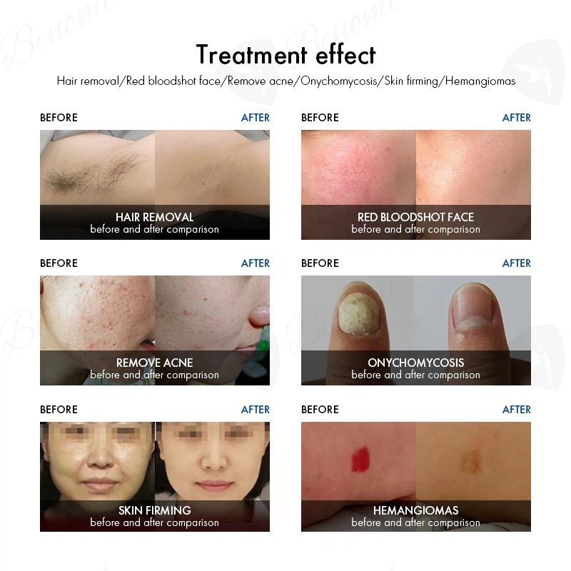 treatment effect